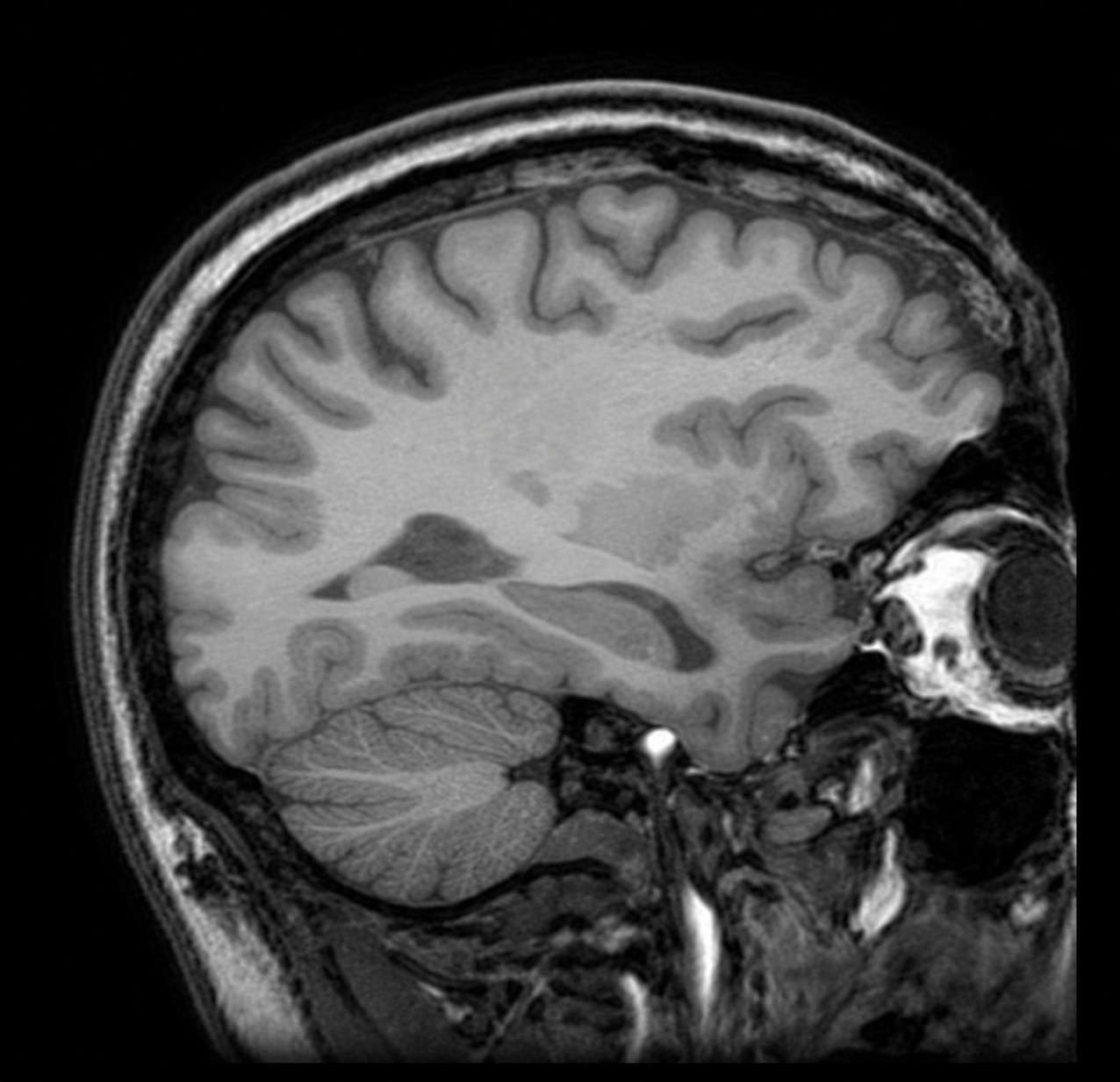 Sagittal brain MRI