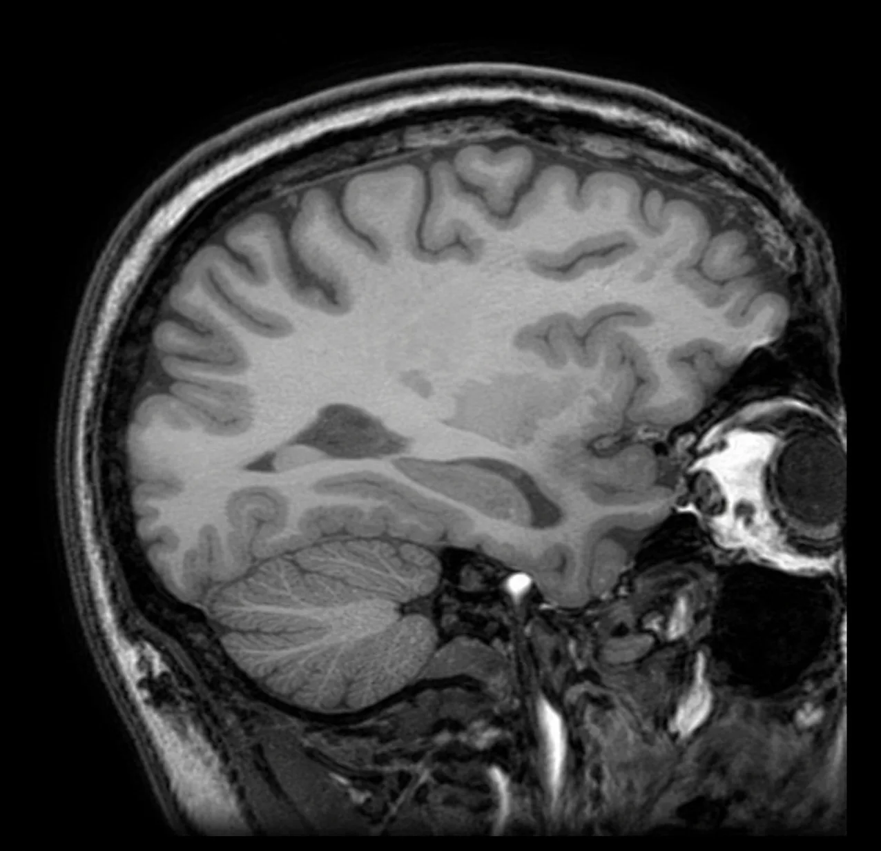Sagittal brain MRI